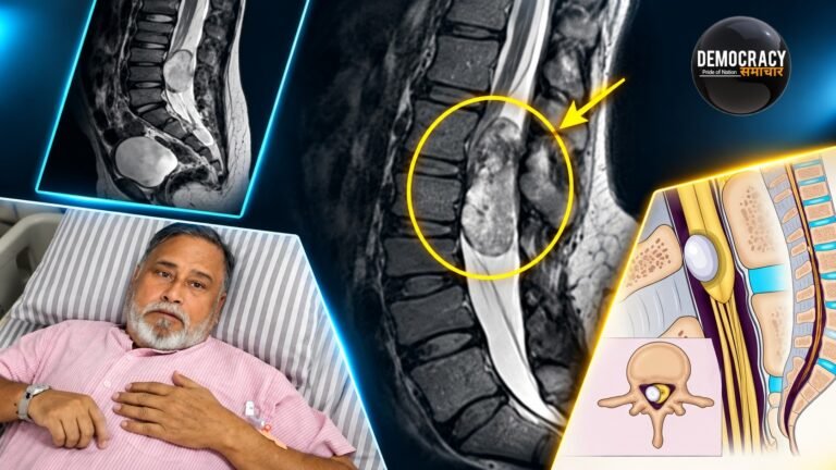 Chicago to Kanpur Spine Surgery: अमेरिका में ढाई करोड़ और 3 महीने का इंतजार, कानपुर में मरीज को मिला 40 हजार में  नया जीवन